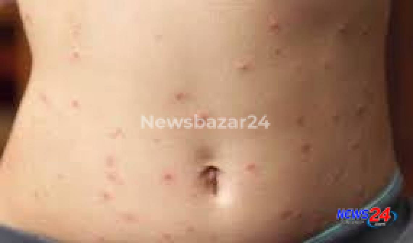 জ্বর নয়, গায়ে র‍্যাশ নিয়ে করোনার চরিত্র বদল, জানালো ইতালি